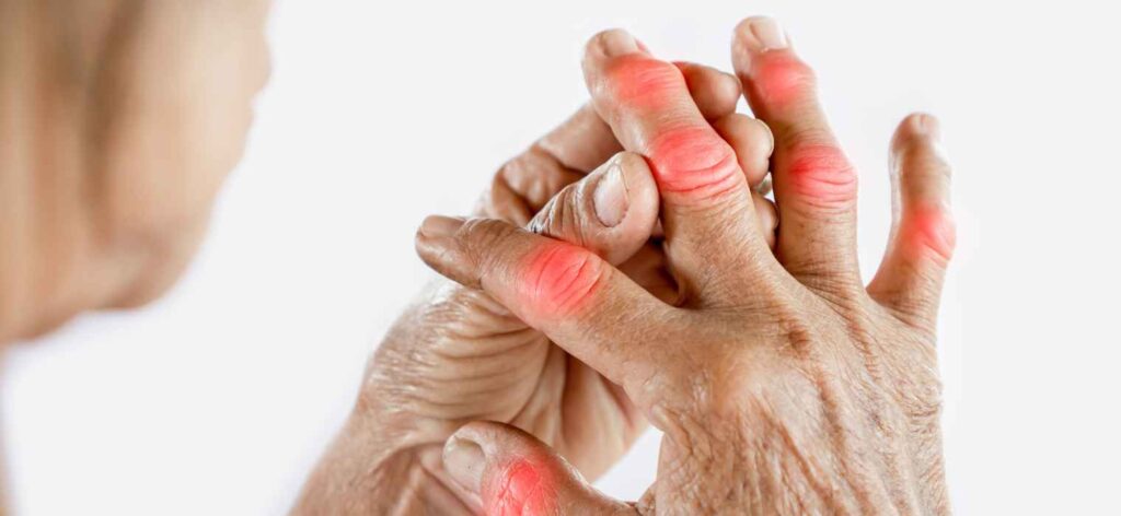 Managing Arthritis Pain: Tips and Treatments for Joint Health